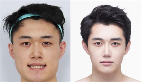 South Korean Men Having Plastic Surgery To Get ‘pretty Boy Looks And