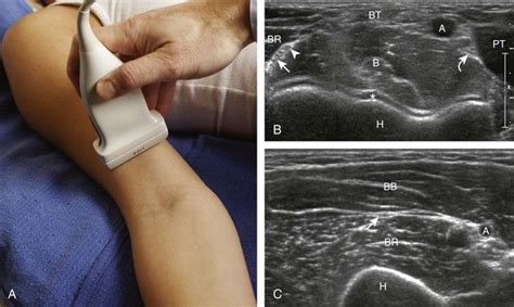 Elbow Ultrasound Ultrasound Diagnostic Medical Sonography Radiology
