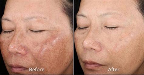 What Is Pih Post Inflammatory Hyperpigmentation Ageless Faces