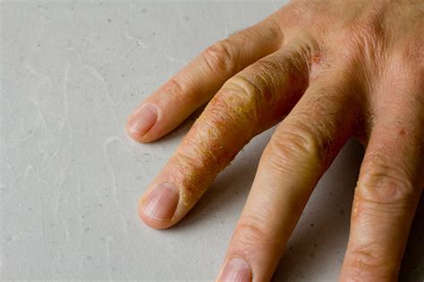 Closeup Of Eczema Dermatitis On Man Hand And Fingers Skin