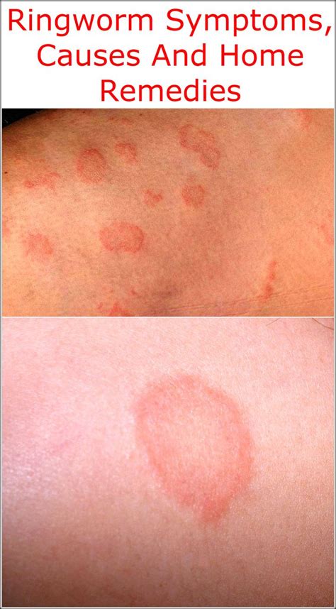 Ringworm Symptoms Causes And Home Remedies In 2020 Ringworm Home