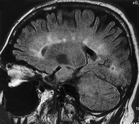 White Matter Diseases Neupsy Key