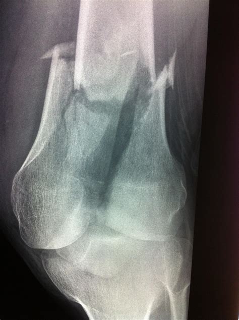 Distal femur fracture treatment, etiology, epidemiology, natural history, anatomy, symptoms, xrays, classification, complications and references. Distal Femur Fractures - Trauma - Orthobullets