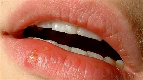 Difference Between Ulcer And Cold Sore Youtube