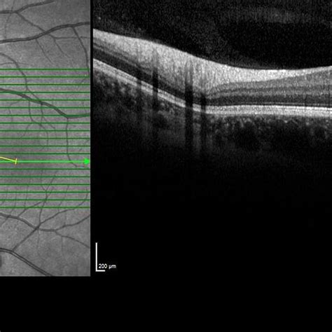 Optical Coherence Tomography Image Shows The Optic Disc Fovea Distance