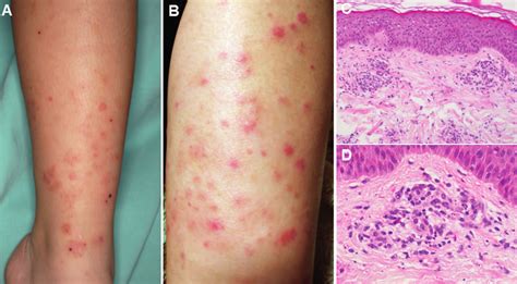 A Numerous Small Erythematous Papules And Plaques Were Present On The Download Scientific