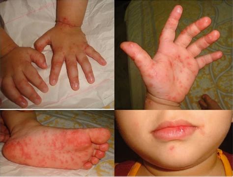 Prevent Your Kiddos From Spreading Hand Foot And Mouth Disease