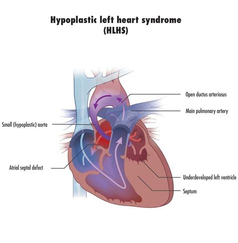 Hypoplastic Left Heart Syndrome Hlhs Pediatric Heart Disease