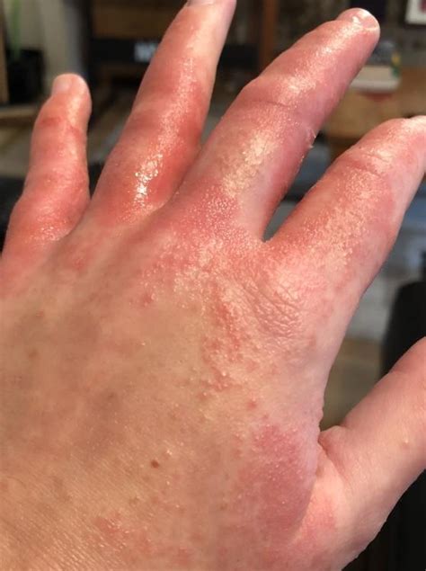 Ver Itchy Inflamed Rash On My Hand Is This A Celiac Rash