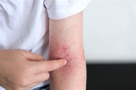 Dermatiti Quali Sono I Tipi Di Dermatite Le Cause E Le Cure