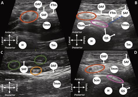 Ultrasound Guided Anterior Approach To The Axillary And