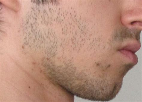 Are These Common Bald Spots Beard Board