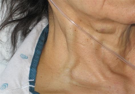 Jugular Vein Distention Jvd Causes Risk Factors And Diagnosis