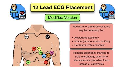 How To Place A Lead Ecg Acronym Mnemonic Diagram For 49 Off