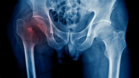 Hip Fractures May Be An Early Sign Of Alzheimers Disease For Older People