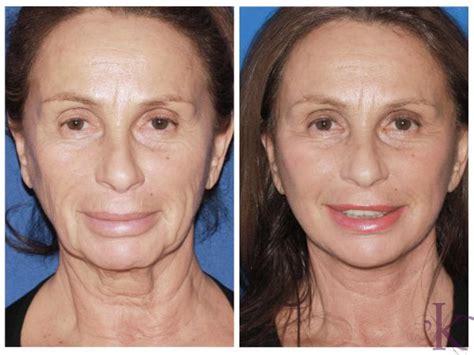 Facelift Case 56 Dr Vasyukevich Facial Plastic Surgeon Nyc