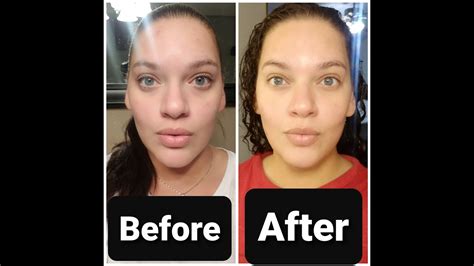 At Home Diy 30 Glycolic Chemical Peel L Step By Step And A Week After W