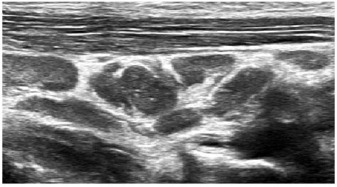Neck Ultrasonography Showing Cluster Of Grapes Appearance Of Lymph