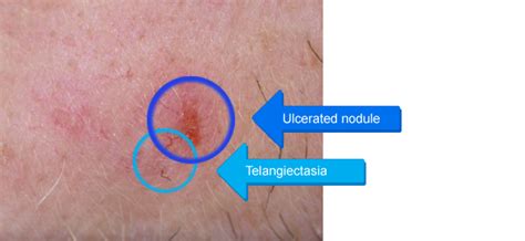 Diagnosis And Management Of Non Melanoma Skin Cancer