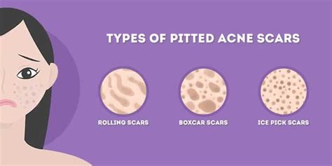 How To Get Rid Of Pitted Acne Scars At Home Skincare Hero