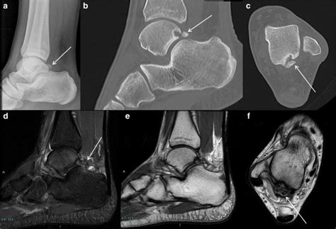 Accessory Ossicles Of The Foot—an Imaging Conundrum Emergency Radiology