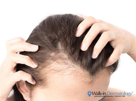 Covid 19 Hair Loss May Be Side Effect Of Viral Infection Walk In