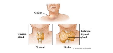 Goiter Definition Pathogenesis Symptoms Treatment And Mcqs For My XXX
