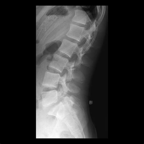 Spondylolisthesis Pacs