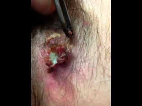 Maybe you shaved or plucked a hair, and when it began to regrow, it managed to turn back into the skin. Ingrown hair / cyst / big pimple | Epic Zit Pop
