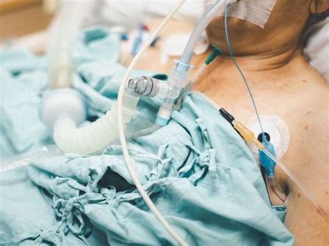 Early Tracheostomy May Be Considered In Severe Covid 19