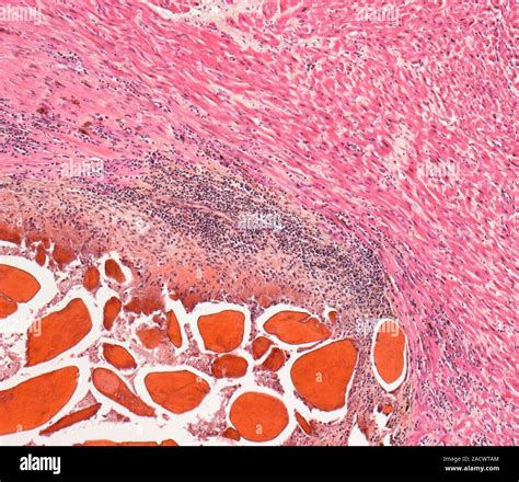 Cardiac Rheumatoid Nodule Light Micrograph Of A Section Through Heart