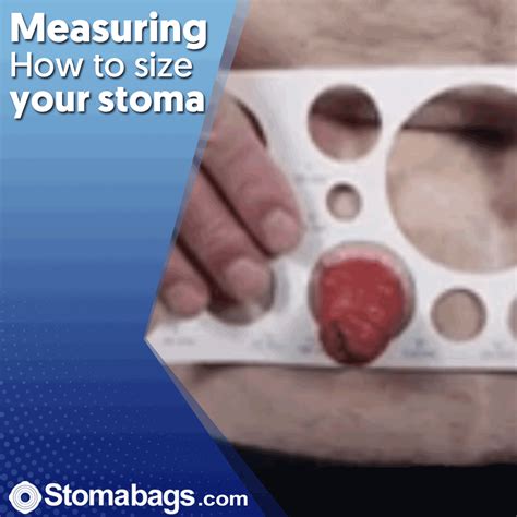 Pin By On Colostomy Ostomy Colostomy Ileostomy