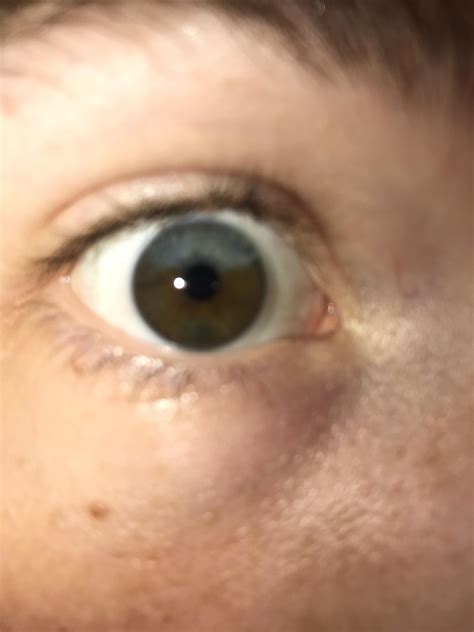 My Sectoral Heterochromia In My Right Eye Rmildlyinteresting