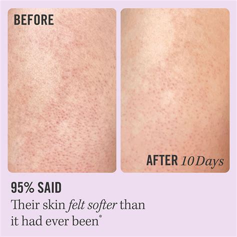 Kp Bump Eraser Body Scrub 10 Aha For Dry Skin First Aid Beauty
