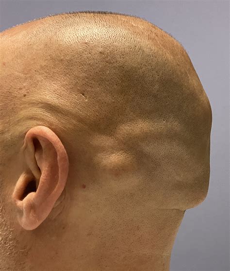 Male Large Occipital Knob Reduction Side 1 Dr Barry Eppley Explore