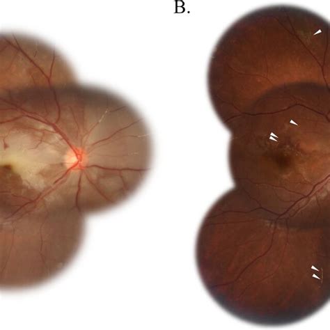 Fundus Photographs A Retinal Artery Occlusion Multiple Filler Embolus
