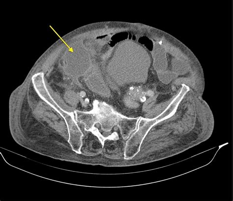 Cureus Spontaneous Gallbladder Perforation A Case Report