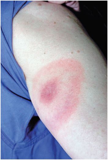 Lyme Disease Definition Demographics Description Causes And Symptoms