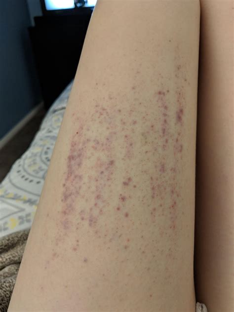Thighs Sometimes React To Heat During Shower And Itch Then Bruise When I Lightly Scratch
