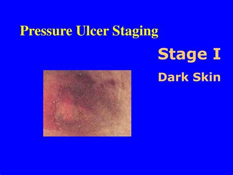 Stage 1 Pressure Ulcer Dark Skin
