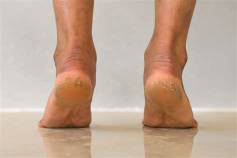 Cracked Heels Causes Home Remedies Prevention And More