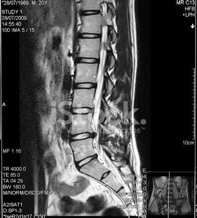 Besides these two questions here we will this mobility of the l5 over s1 and disc which is located in the lowest part of the body; L4 L5 Disc Herniaton Stock Photos - FreeImages.com