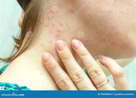 Purulent Rashes On The Neck Of Woman Allergy Acne Stock Image Image