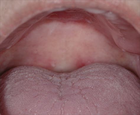 Successful Treatment Of Mucous Membrane Pemphigoid With Infliximab