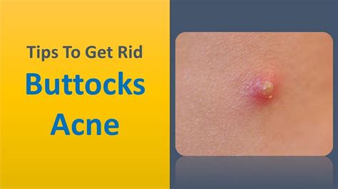 Tips To Get Rid Buttocks Acne Miracle Tip To Remove Buttocks Acne