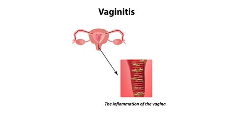 What Causes Vaginitis Pristyn Care