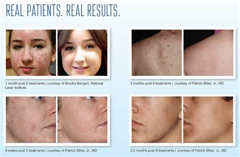 Forever Clear Bbl Acne Treatment Fort Lauderdale Fl