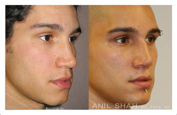 Other male patients prefer to have a slightly sloped profile with a supratip break and the tip raised to about 95 degrees. About Getting The Very Best Male Nose Job ...