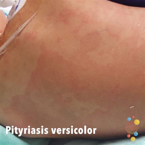 Pityriasis Versicolor Skin Deep