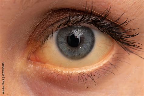 A Closeup View On The Eye Of A Young Caucasian Adult With Yellowing Of